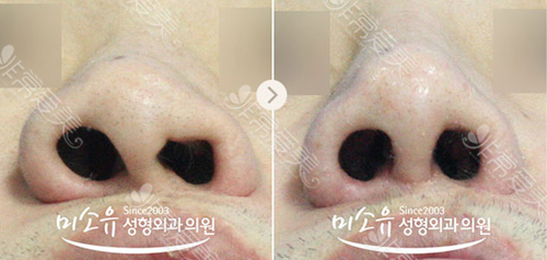 韩国美所有整形外科唇裂鼻孔整形案例