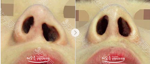 韩国美所有整形外科唇裂鼻孔整形案例