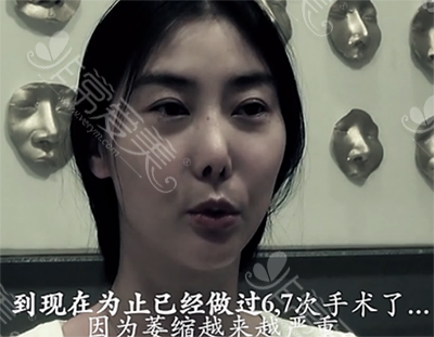 经历过六七次手术的鼻部状态 经历过六七次手术的鼻部状态