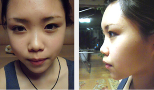 韩国美plus整形外科鼻修复术前照片