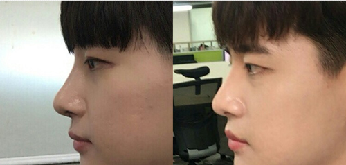 韩国glory整形外科隆鼻术前术后对比