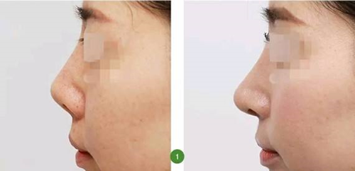 一个鼻子顶多能做几次？在韩国做高难度鼻修复哪家好？