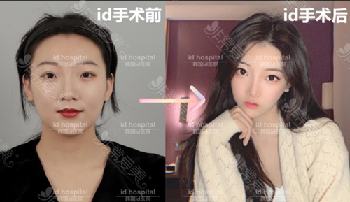 韩国ID整形外科面部轮廓前后图