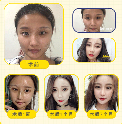 韩国ID整形外科面部轮廓案例