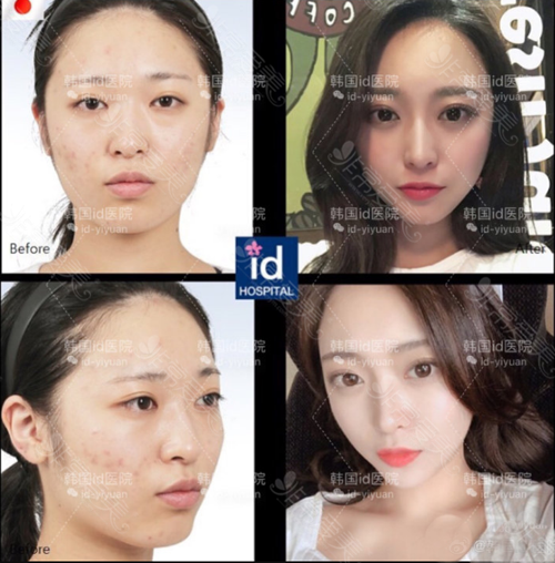 韩国ID整形外科面部轮廓案例