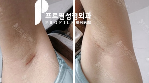 韩国普罗菲耳Profile假体隆胸术后疤痕图