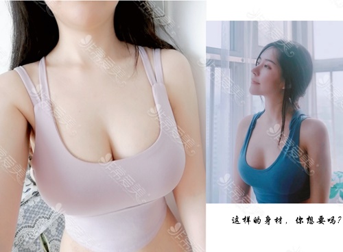 韩国普罗菲耳Profile隆胸真人案例
