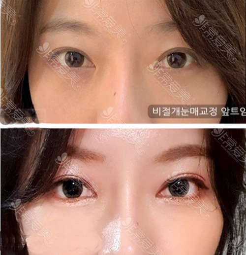 韩国艾恩整形外科双眼皮案例