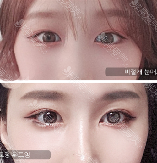 韩国艾恩整形外科双眼皮案例