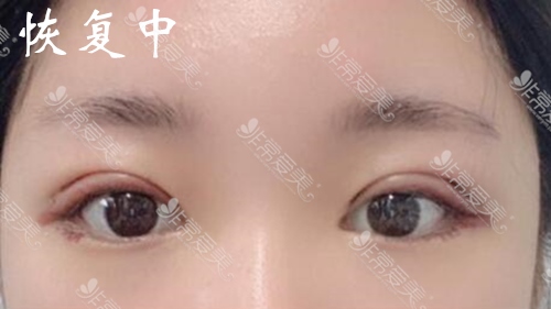 韩国laforet整形双眼皮恢复过程图