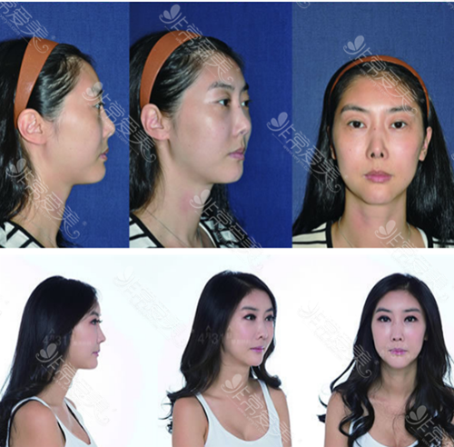 韩国4月31日整形外科第七次鼻修复手术案例