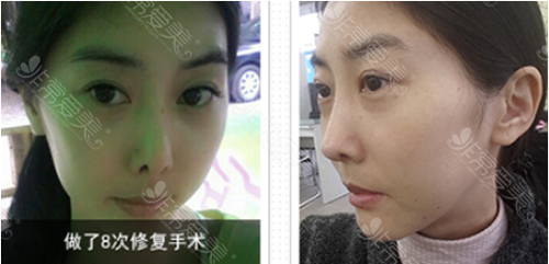 韩国4月31日整形外科鼻修复案例