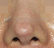假体隆鼻后遗症图片