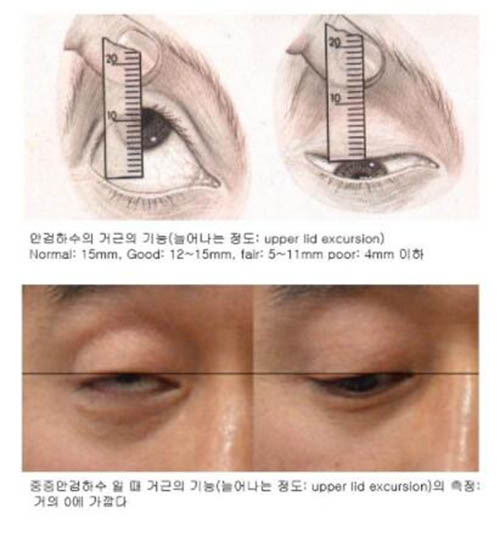 韩国Area88医疗美容医院提肌改善