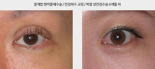 韩国Area88医疗美容双眼皮修复案例