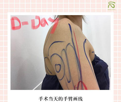 韩国延世slimline医院手臂吸脂术前照片