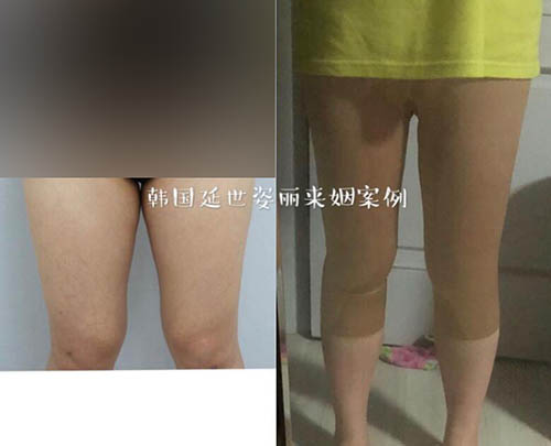韩国延世slimline大腿吸脂前后对比照片