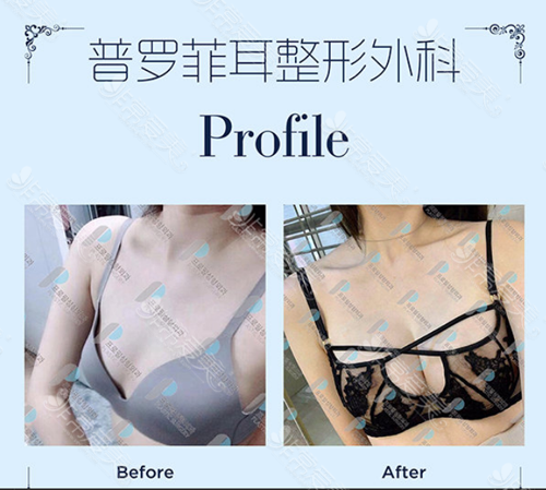 韩国普罗菲耳整形外科假体隆胸案例