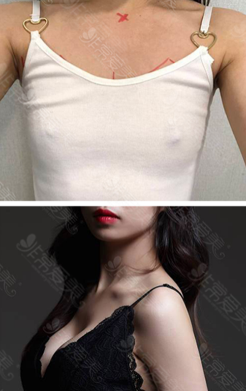 韩国普罗菲耳整形外科假体隆胸案例