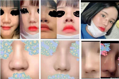 韩国玉芭整形外科隆鼻效果好吗