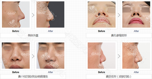 韩国GNG整形医院各类鼻修复手术案例