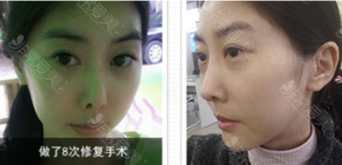 韩国4月31日整形外科第八次鼻修复手术案例