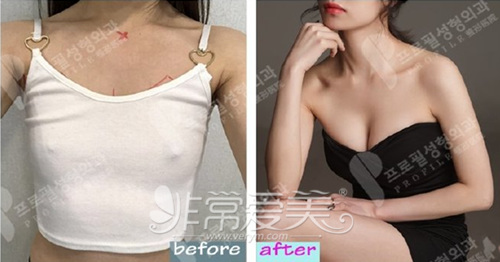 韩国普罗菲耳乳房整形前后变化图