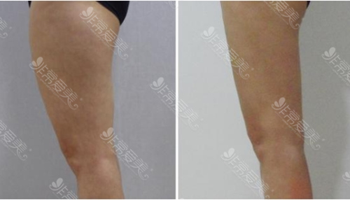 韩国modelline腿部吸脂手术图片