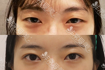 韩国纯真医院双眼皮手术案例一