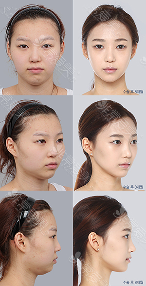 韩国DA整形外科面部轮廓案例二