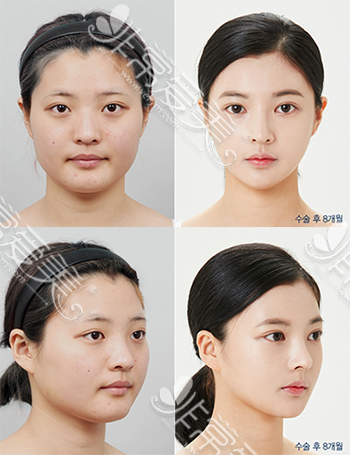 韩国DA整形外科面部轮廓案例