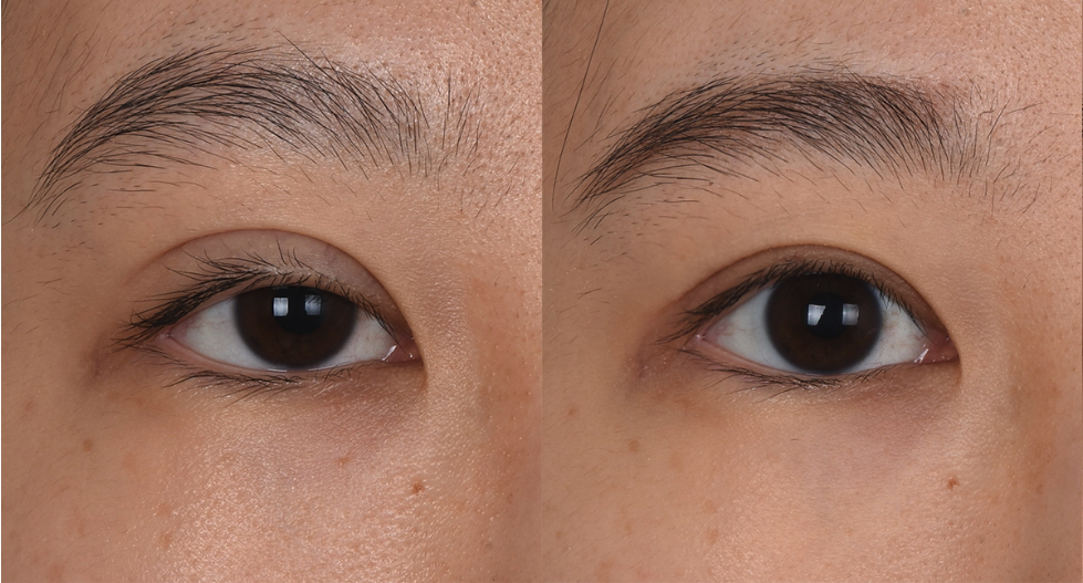 双眼皮修复的可以只做一只吗?