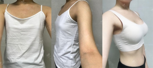 韩国光面假体隆胸手术对比图