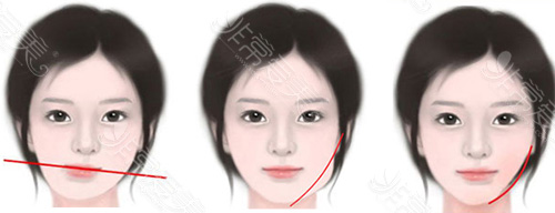 面部不对称该如何矫正，韩国哪位院长矫正效果好？