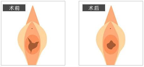 处女膜修复对比动漫图韩国hansarang妇科医院处女膜修复对比图
