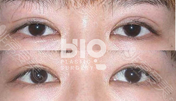 韩国BIO双眼皮修复案例三