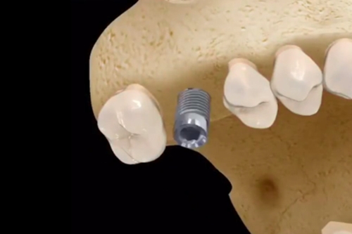 bego种植牙手术步骤是什么