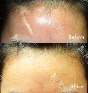 韩国Dr.ham's前额疤痕祛除案例
