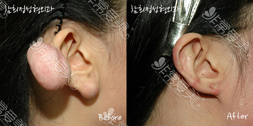 韩国Dr.ham's外耳廓祛疤案例