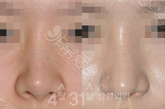 韩国4月31日整形鼻修复案例