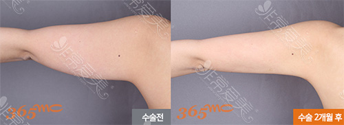 韩国365mc医院上臂吸脂案例对比
