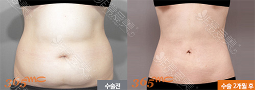韩国365mc医院腰腹吸脂对比图