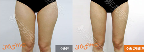 韩国365mc医院大腿吸脂效果对比图