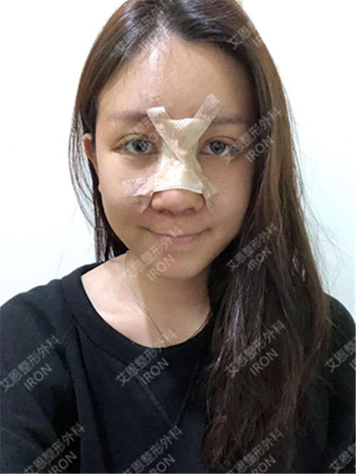 在韩国艾恩做隆鼻过程图