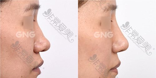 韩国GNG整形外科自体软骨隆鼻修复案例