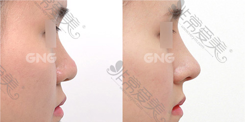 韩国GNG整形外科自体软骨隆鼻案例