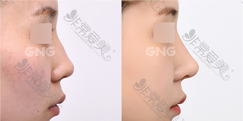 韩国GNG整形外科自体软骨隆鼻效果