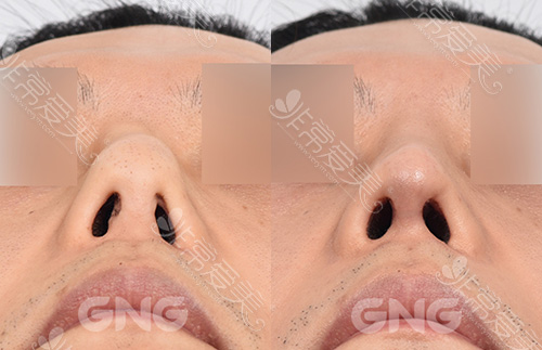 韩国GNG整形自体软骨隆鼻鼻孔修正