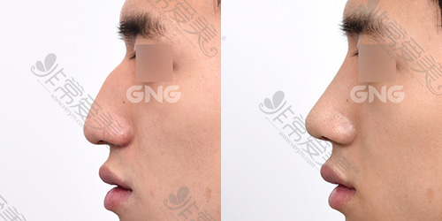 韩国GNG整形自体软骨男性鹰钩鼻修复案例