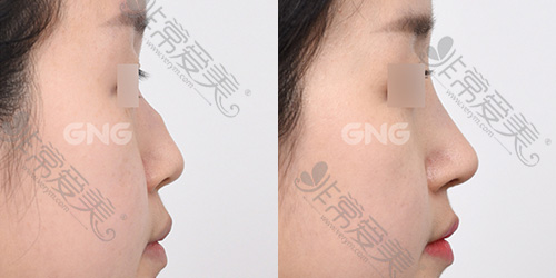 韩国GNG整形自体软骨女性鹰钩鼻修复案例